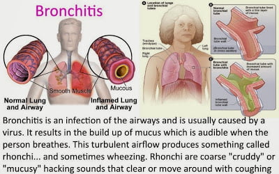 apa-itu-pneumonia-bronkitis-kepada-kanak-kanak
