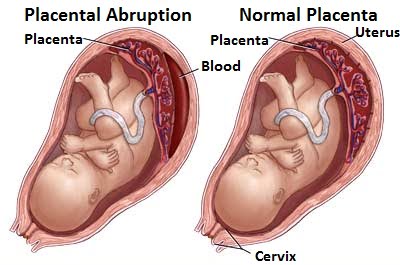 Placental-Abruption-5-penyebab-pendarahan-ketika-hamil-spotting