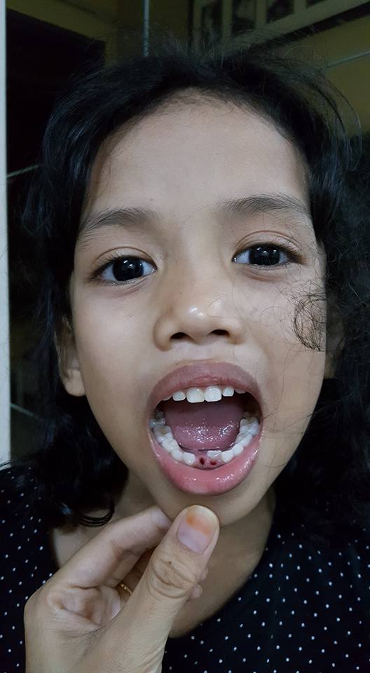 gigi-susu-hannah-damia-dicabut