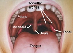 apa-itu-radang-tonsil-tonsillitis apa-itu-radang-tonsil-tonsillitis