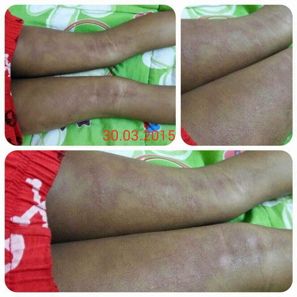 CARA MERAWAT EKZEMA DAN PSORIASIS - PENYAKIT KULIT PADA BAYI - CUBA BEDAK ASMAK (1)