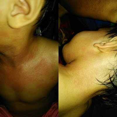 CARA MERAWAT EKZEMA DAN PSORIASIS - PENYAKIT KULIT PADA BAYI - CUBA BEDAK ASMAK (2)