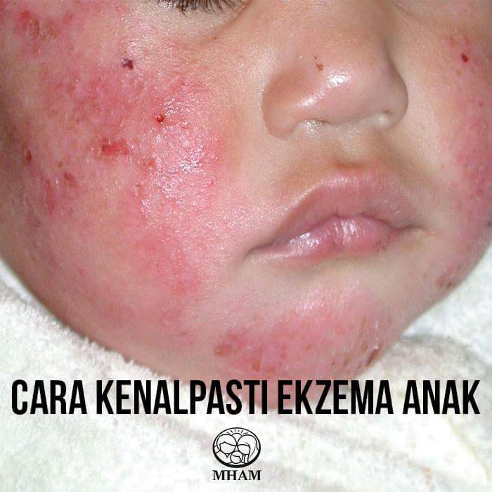 CARA MERAWAT EKZEMA DAN PSORIASIS - PENYAKIT KULIT PADA BAYI - CUBA BEDAK ASMAK (4)