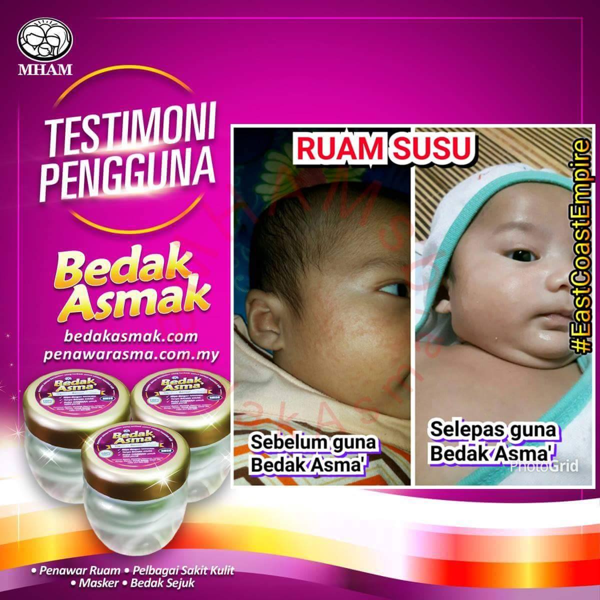 CARA MERAWAT EKZEMA DAN PSORIASIS - PENYAKIT KULIT PADA BAYI - CUBA BEDAK ASMAK (7)