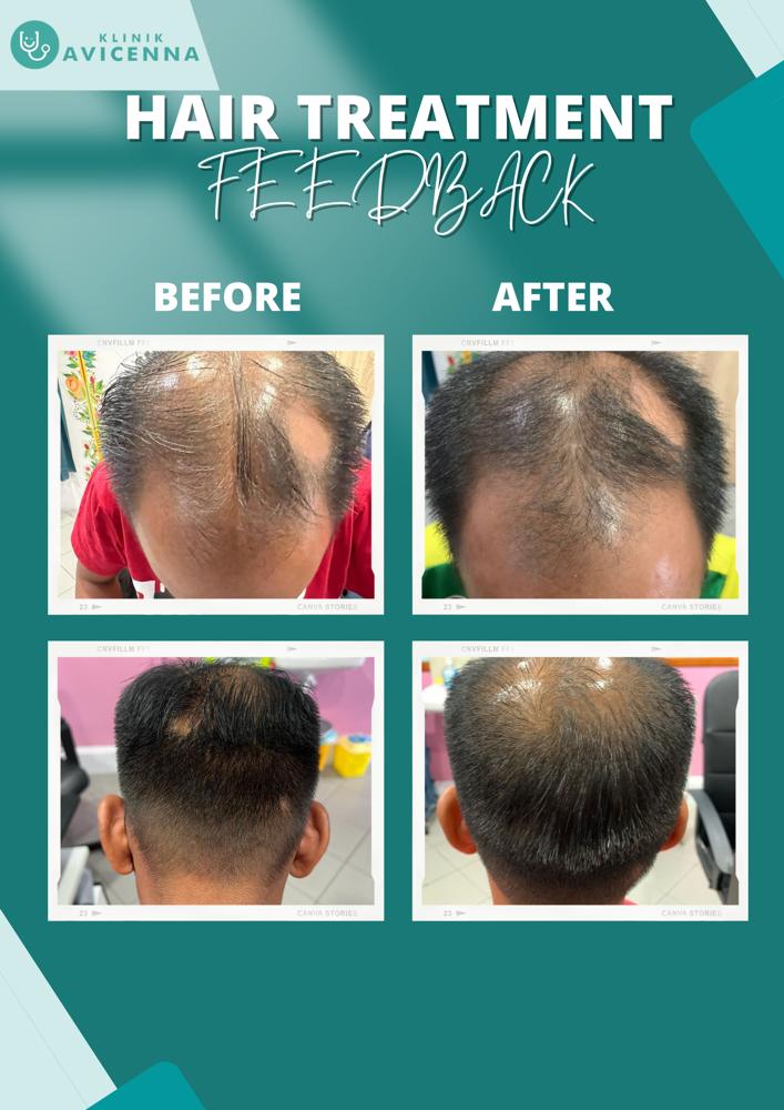 MASALAH RAMBUT GUGUR : KENAPA RAMBUT GUGUR BANYAK SETIAP HARI?