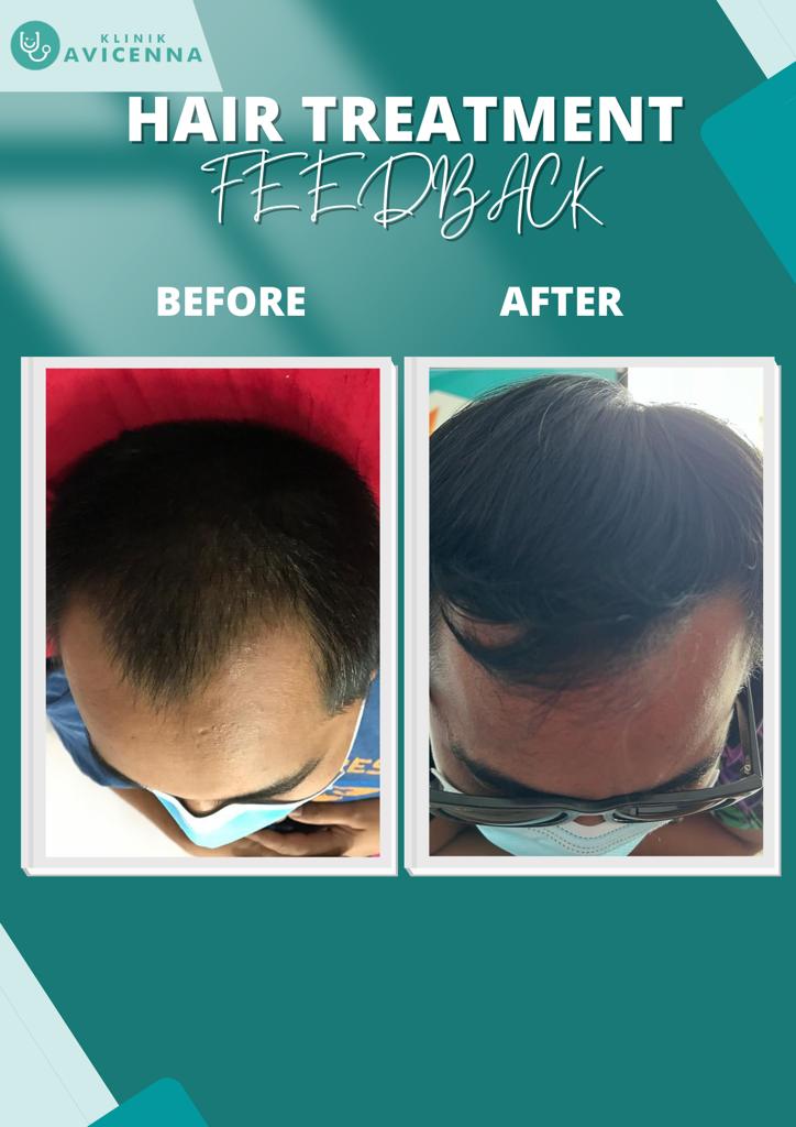 MASALAH RAMBUT GUGUR : KENAPA RAMBUT GUGUR BANYAK SETIAP HARI?