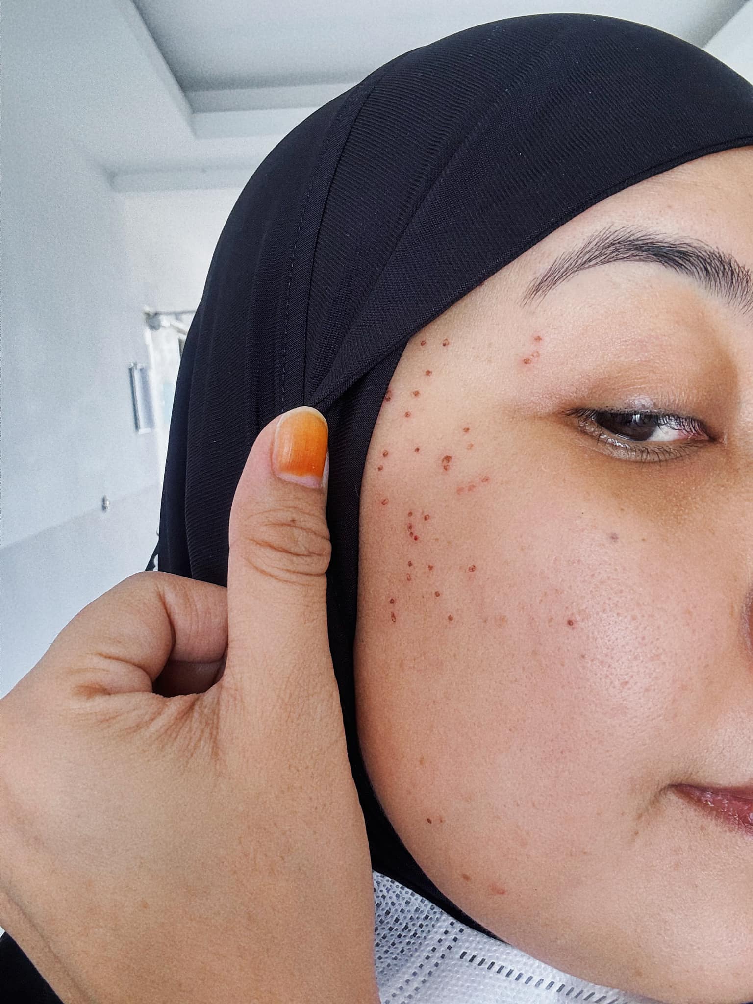 buang kutil muka