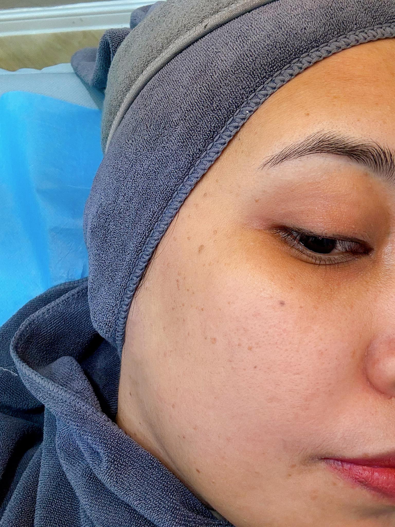 buang kutil muka