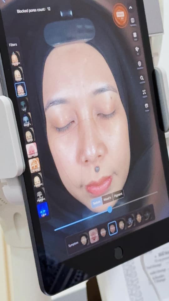 buang kutil muka